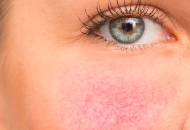 Rosacea